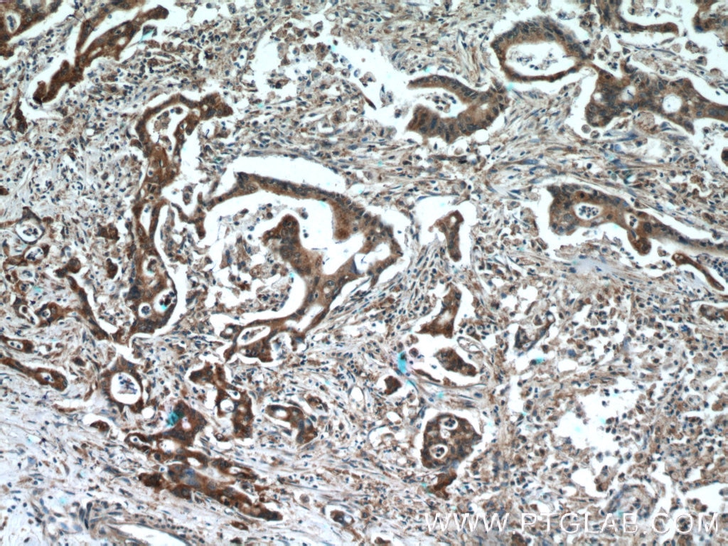 IHC staining of human pancreas cancer using 12035-1-AP