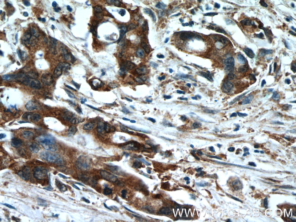 Immunohistochemistry (IHC) staining of human pancreas cancer tissue using KIF12 Polyclonal antibody (12035-1-AP)