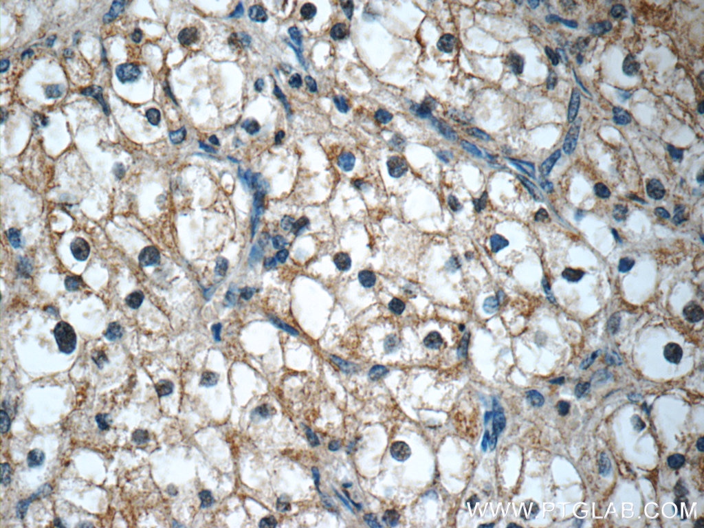 Immunohistochemistry (IHC) staining of human renal cell carcinoma tissue using KIF12 Polyclonal antibody (12035-1-AP)