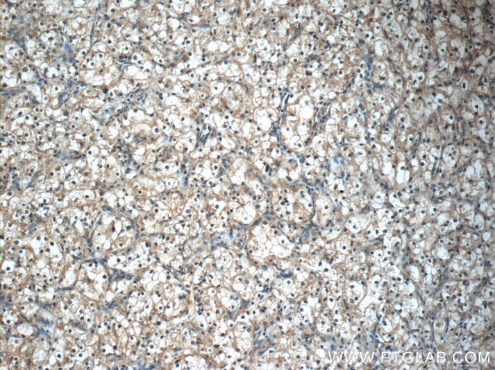 IHC staining of human renal cell carcinoma using 12035-1-AP
