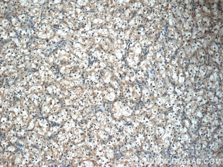 Immunohistochemistry (IHC) staining of human renal cell carcinoma tissue using KIF12 Polyclonal antibody (12035-1-AP)