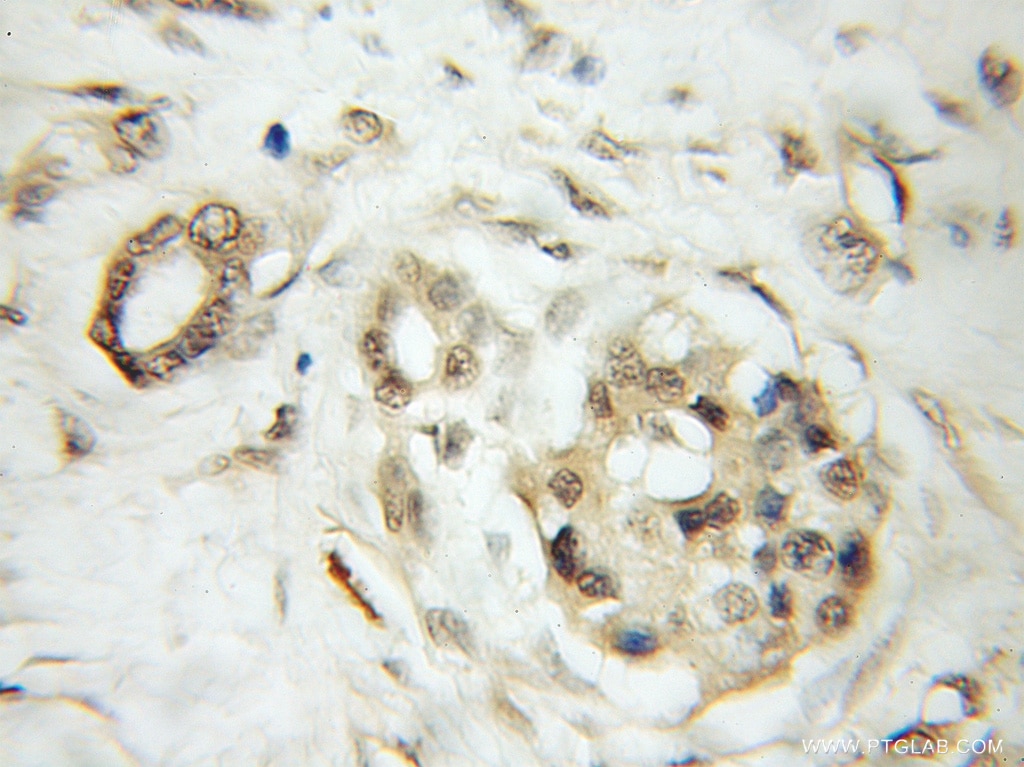 Immunohistochemistry (IHC) staining of human pancreas cancer tissue using KIF12 Polyclonal antibody (12035-1-AP)