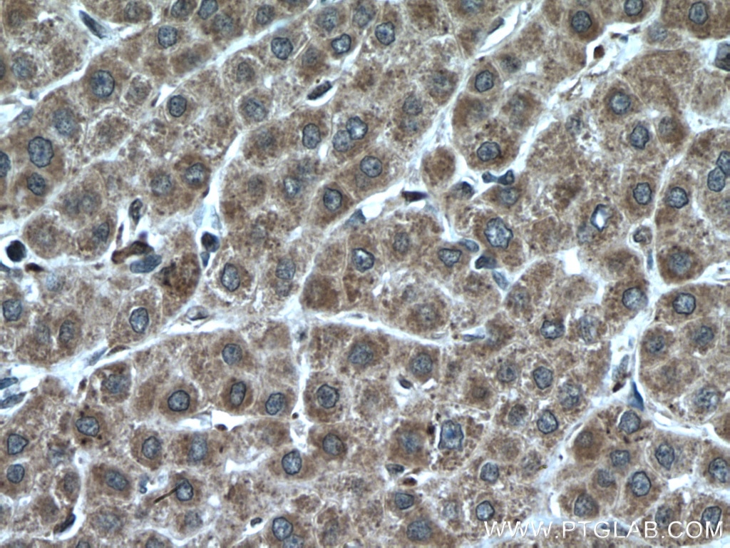 Immunohistochemistry (IHC) staining of human liver cancer tissue using KIF13A Polyclonal antibody (27210-1-AP)