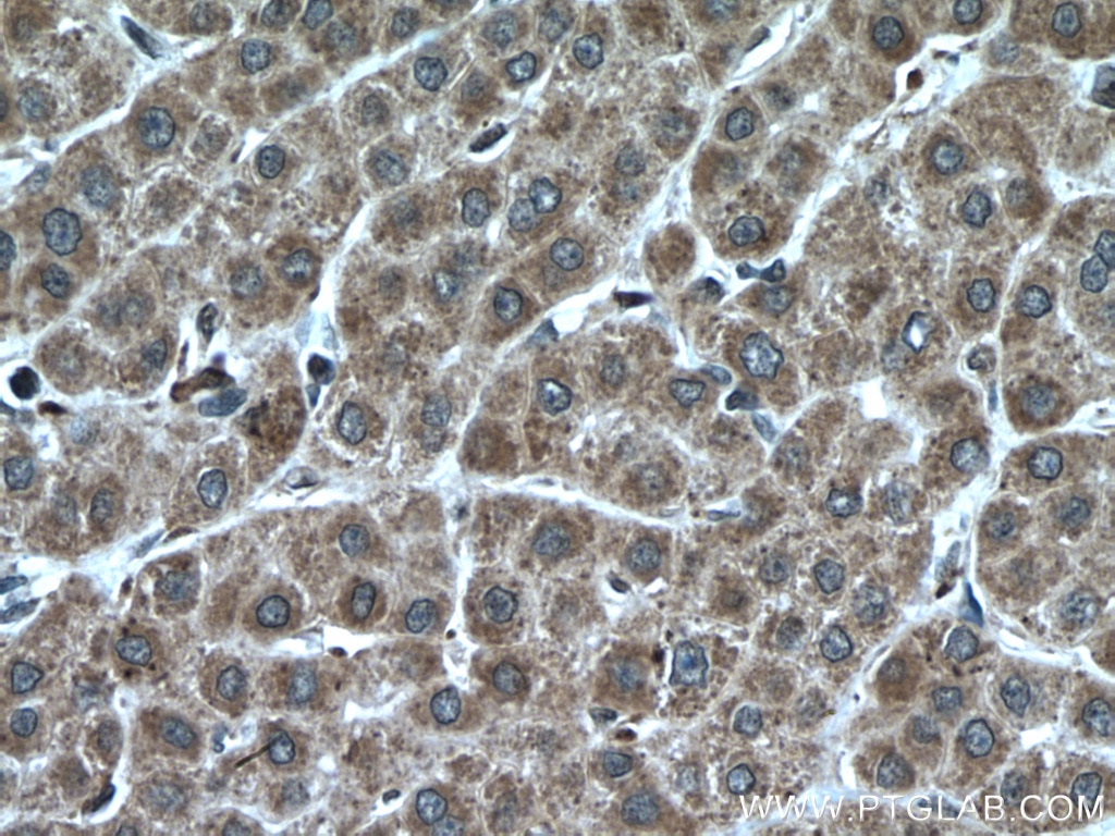 Immunohistochemistry (IHC) staining of human liver cancer tissue using KIF13A Polyclonal antibody (27210-1-AP)