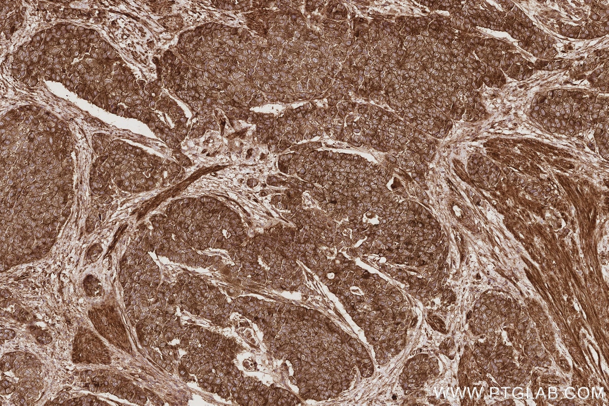 IHC staining of human stomach cancer using 27210-1-AP Immunohistochemistry (IHC) staining of human stomach cancer tissue using KIF13A Polyclonal antibody (27210-1-AP)