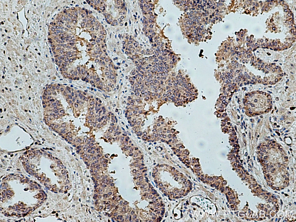Immunohistochemistry (IHC) staining of human prostate cancer tissue using KIF14 Polyclonal antibody (26000-1-AP)