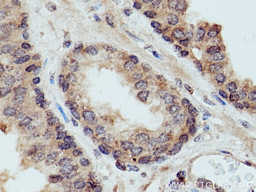 Immunohistochemistry (IHC) staining of human prostate cancer tissue using KIF14 Polyclonal antibody (26000-1-AP)