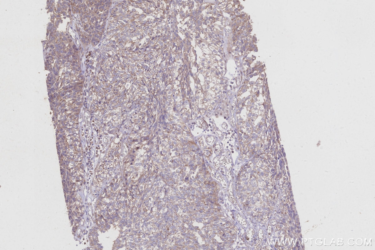 Immunohistochemistry (IHC) staining of human ovary cancer tissue using KIF15 Polyclonal antibody (30774-1-AP)