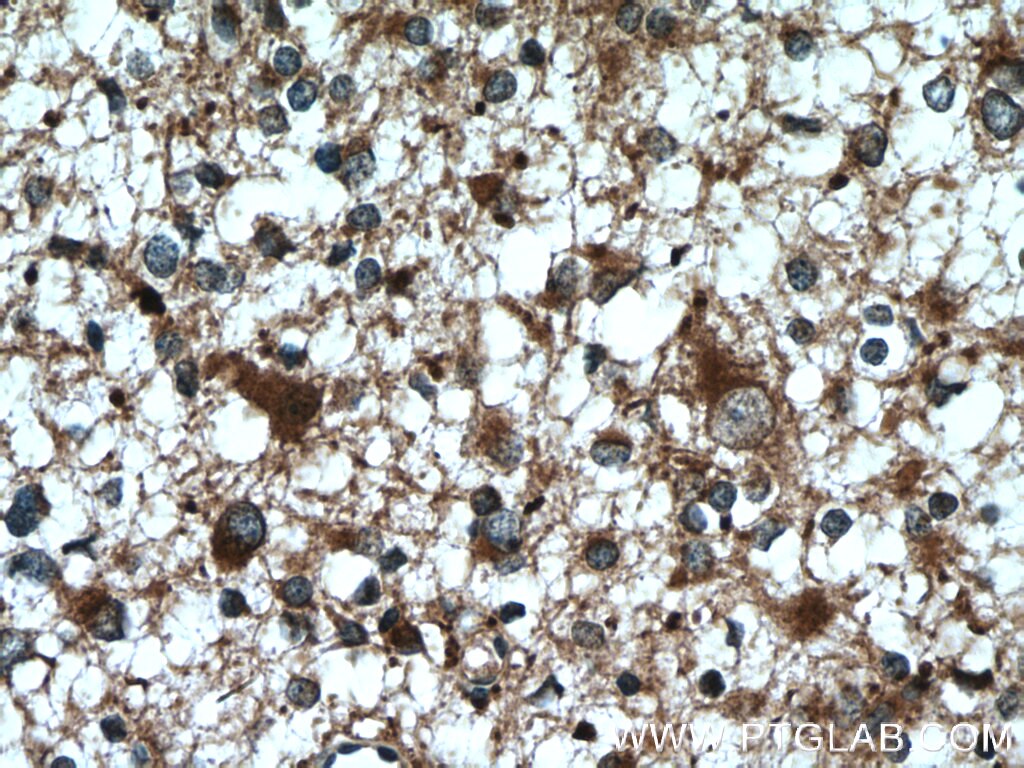 Immunohistochemistry (IHC) staining of human gliomas tissue using KIF17 Polyclonal antibody (14615-1-AP)