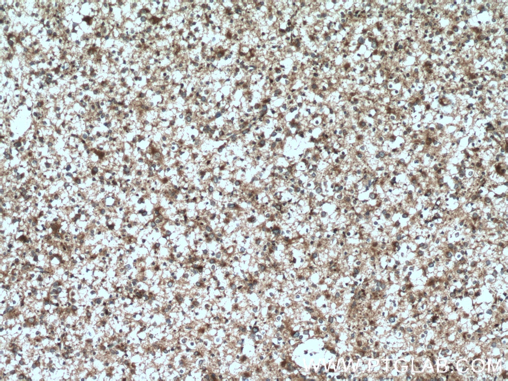 Immunohistochemistry (IHC) staining of human gliomas tissue using KIF17 Polyclonal antibody (14615-1-AP)