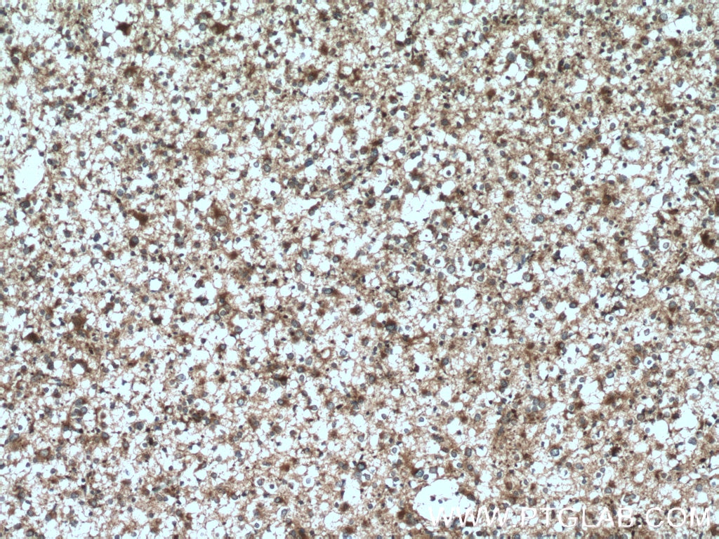 IHC staining of human gliomas using 14615-1-AP