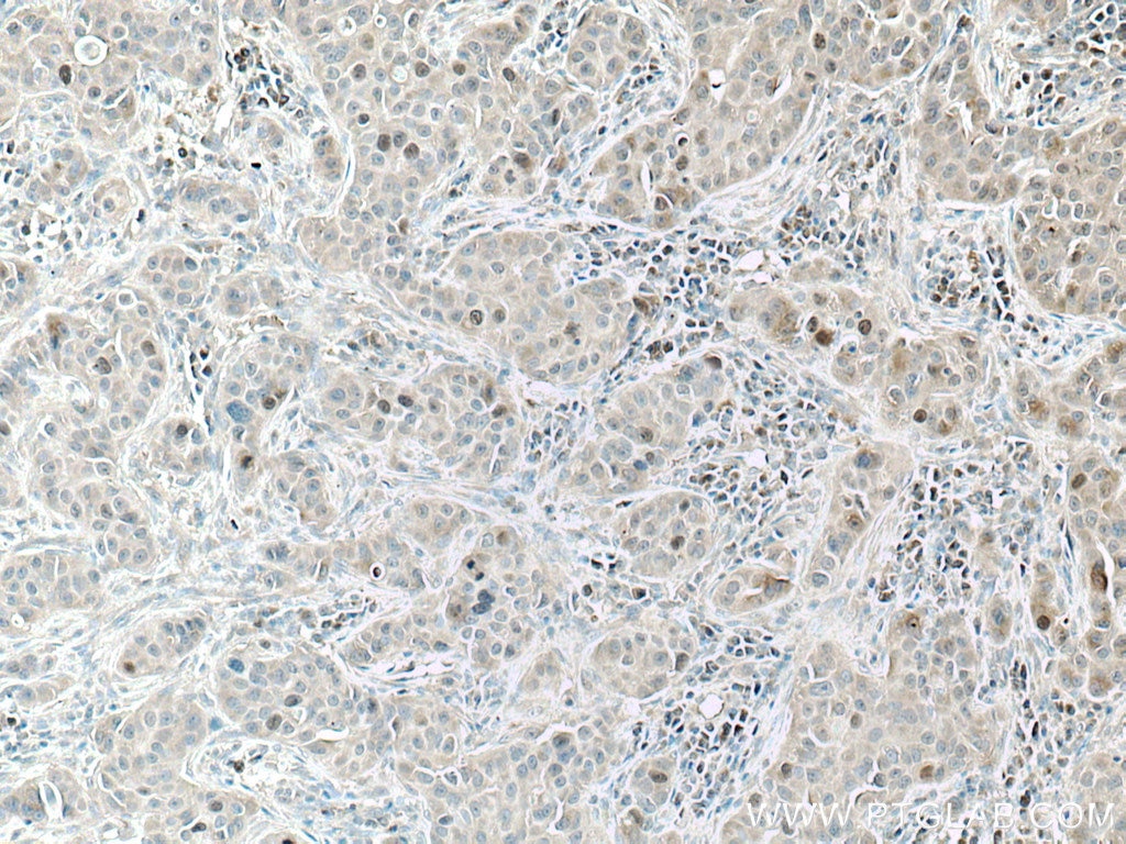 Immunohistochemistry (IHC) staining of human breast cancer tissue using KIF18A Polyclonal antibody (19245-1-AP)