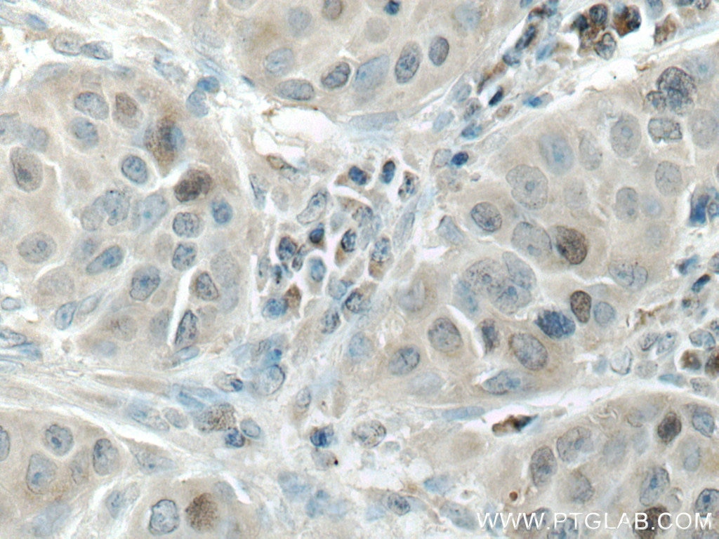 Immunohistochemistry (IHC) staining of human breast cancer tissue using KIF18A Polyclonal antibody (19245-1-AP)