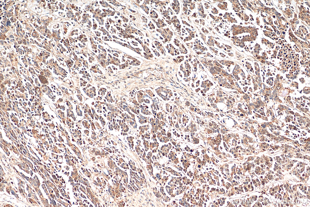 Immunohistochemistry (IHC) staining of human colon cancer tissue using KIF18A Polyclonal antibody (19245-1-AP)