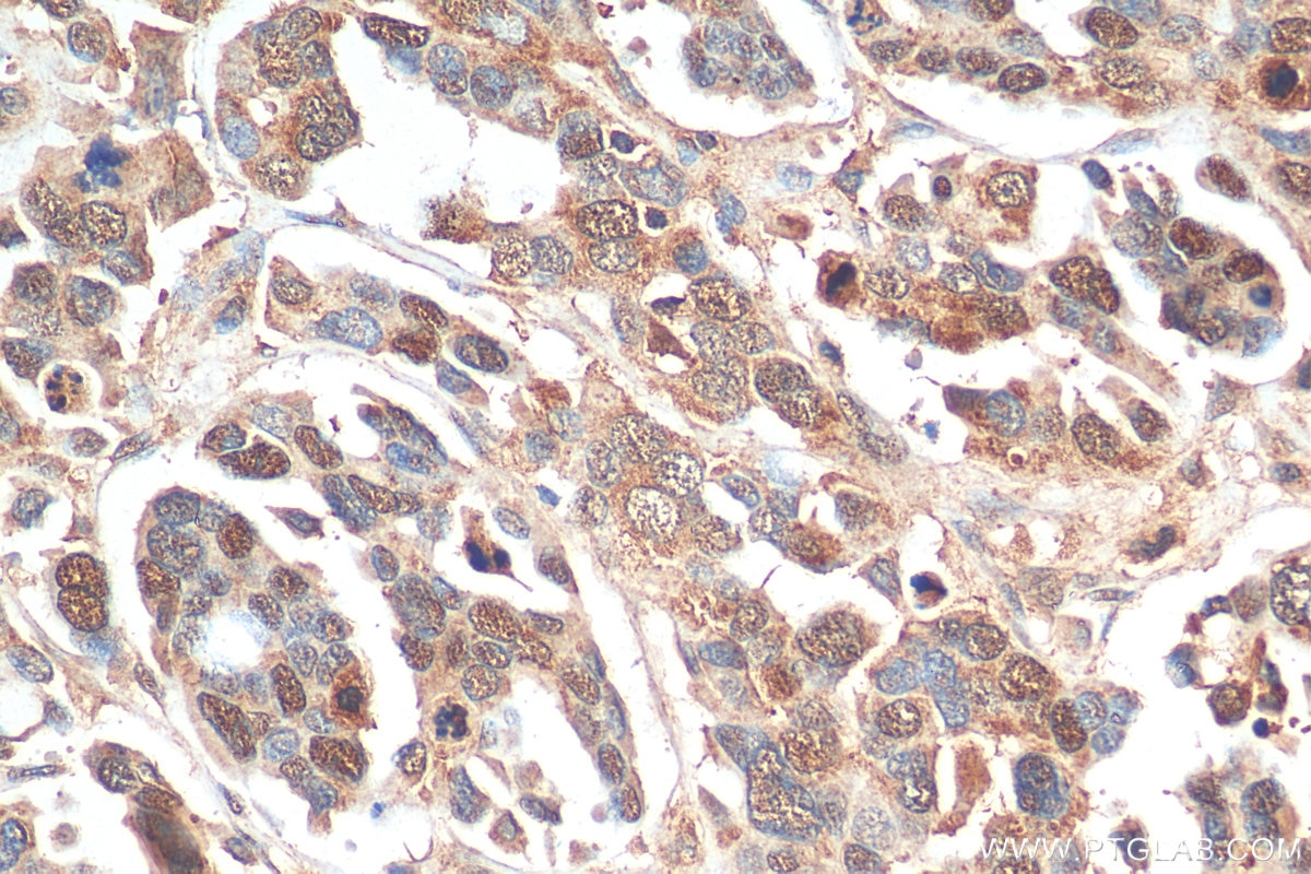 Immunohistochemistry (IHC) staining of human colon cancer tissue using KIF18A Polyclonal antibody (19245-1-AP)