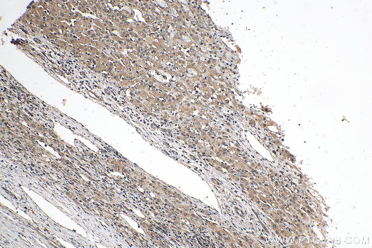 Immunohistochemistry (IHC) staining of human liver cancer tissue using KIF1B Polyclonal antibody (15263-1-AP)