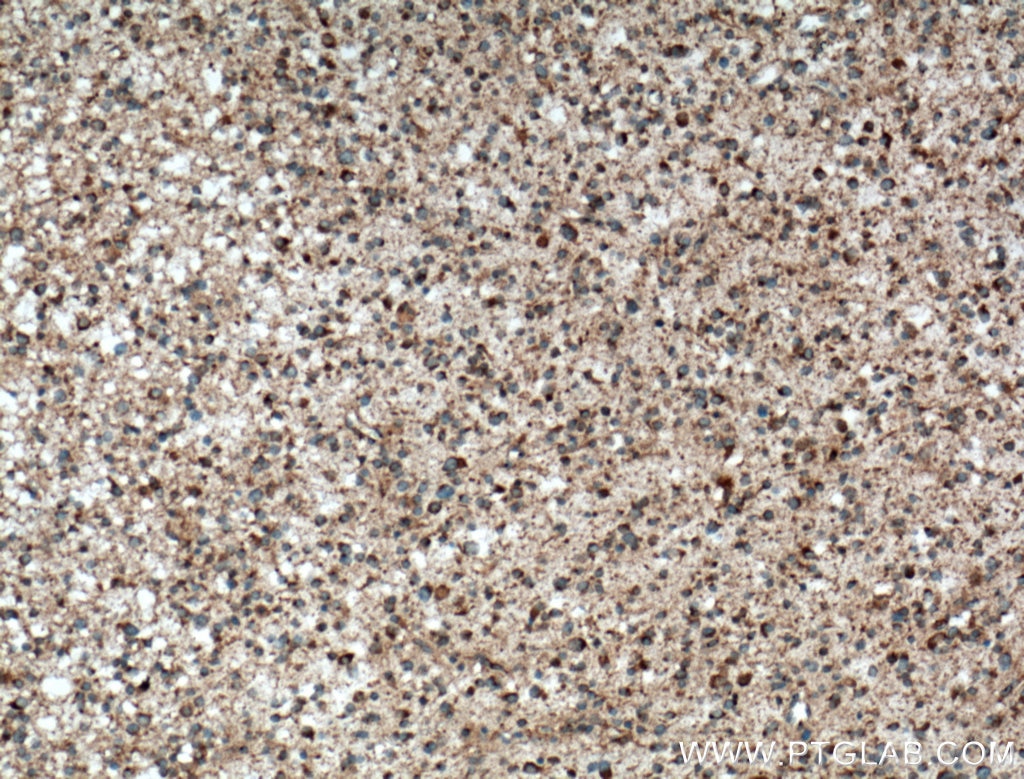 Immunohistochemistry (IHC) staining of human gliomas tissue using KIF1C Polyclonal antibody (12760-1-AP)