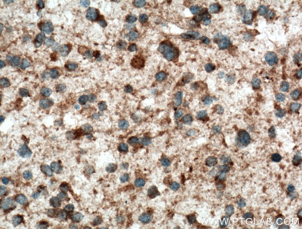 IHC staining of human gliomas using 12760-1-AP