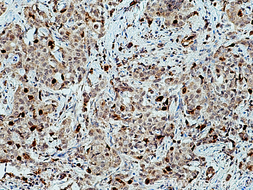 Immunohistochemistry (IHC) staining of human breast cancer tissue using KIF20A Polyclonal antibody (15911-1-AP)