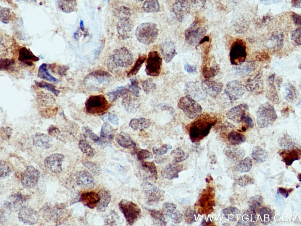 Immunohistochemistry (IHC) staining of human breast cancer tissue using KIF20A Polyclonal antibody (15911-1-AP)