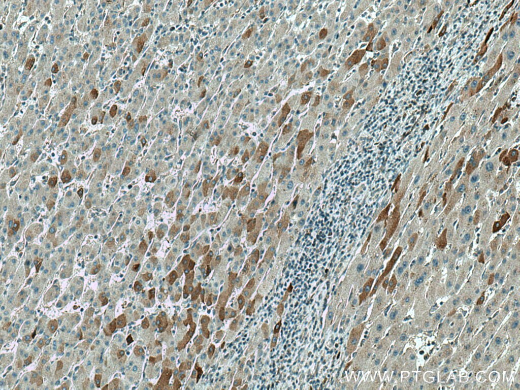 Immunohistochemistry (IHC) staining of human liver cancer tissue using KIF20A Polyclonal antibody (15911-1-AP)