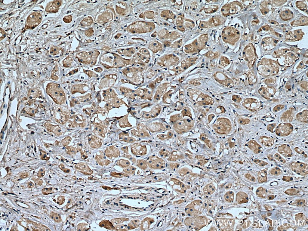 Immunohistochemistry (IHC) staining of human breast cancer tissue using KIF20A Monoclonal antibody (67190-1-Ig)