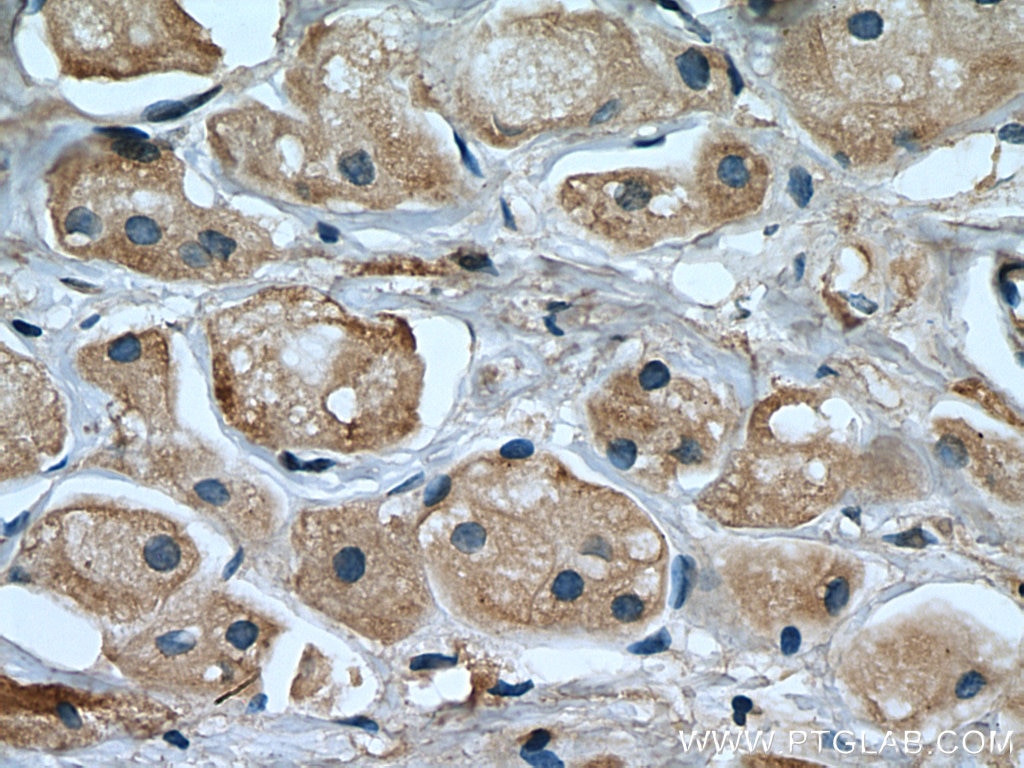 Immunohistochemistry (IHC) staining of human breast cancer tissue using KIF20A Monoclonal antibody (67190-1-Ig)