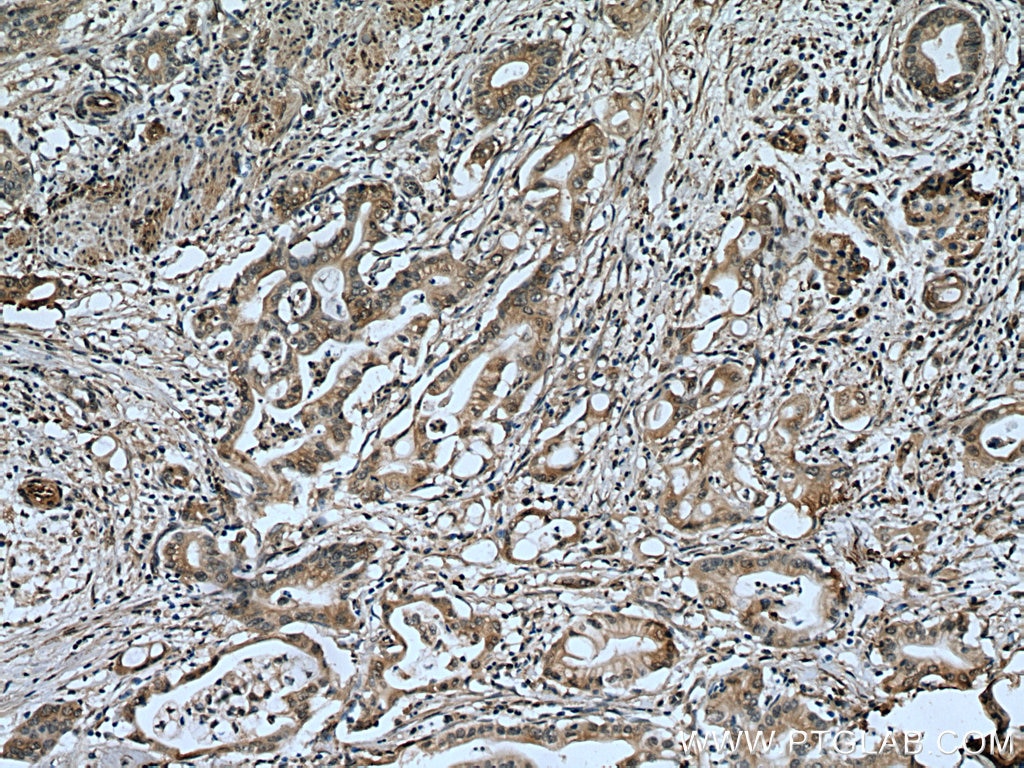 Immunohistochemistry (IHC) staining of human pancreas cancer tissue using KIF20A Monoclonal antibody (67190-1-Ig)