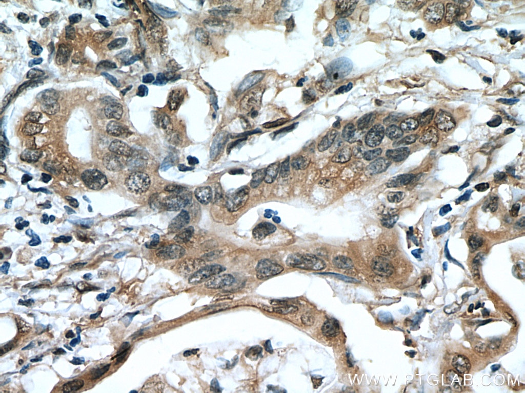 IHC staining of human pancreas cancer using 67190-1-Ig