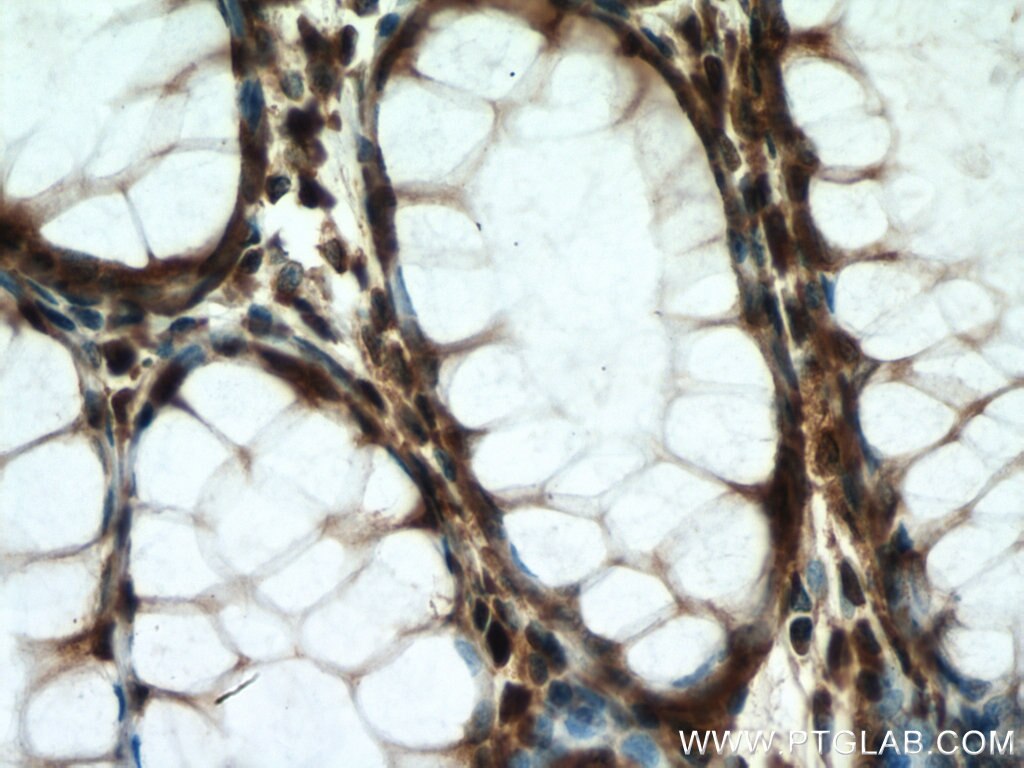 Immunohistochemistry (IHC) staining of human colon cancer tissue using KIF20B Polyclonal antibody (27269-1-AP)