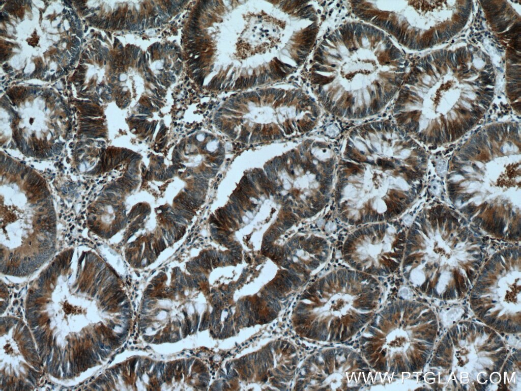 Immunohistochemistry (IHC) staining of human colon cancer tissue using KIF20B Polyclonal antibody (27269-1-AP)