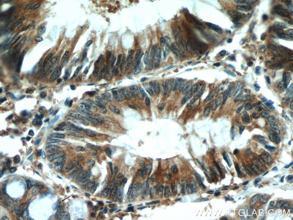 Immunohistochemistry (IHC) staining of human colon cancer tissue using KIF20B Polyclonal antibody (27269-1-AP)