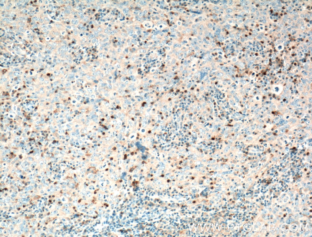 Immunohistochemistry (IHC) staining of human breast cancer tissue using KIF22 Polyclonal antibody (13403-1-AP)
