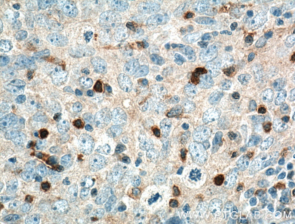 Immunohistochemistry (IHC) staining of human breast cancer tissue using KIF22 Polyclonal antibody (13403-1-AP)