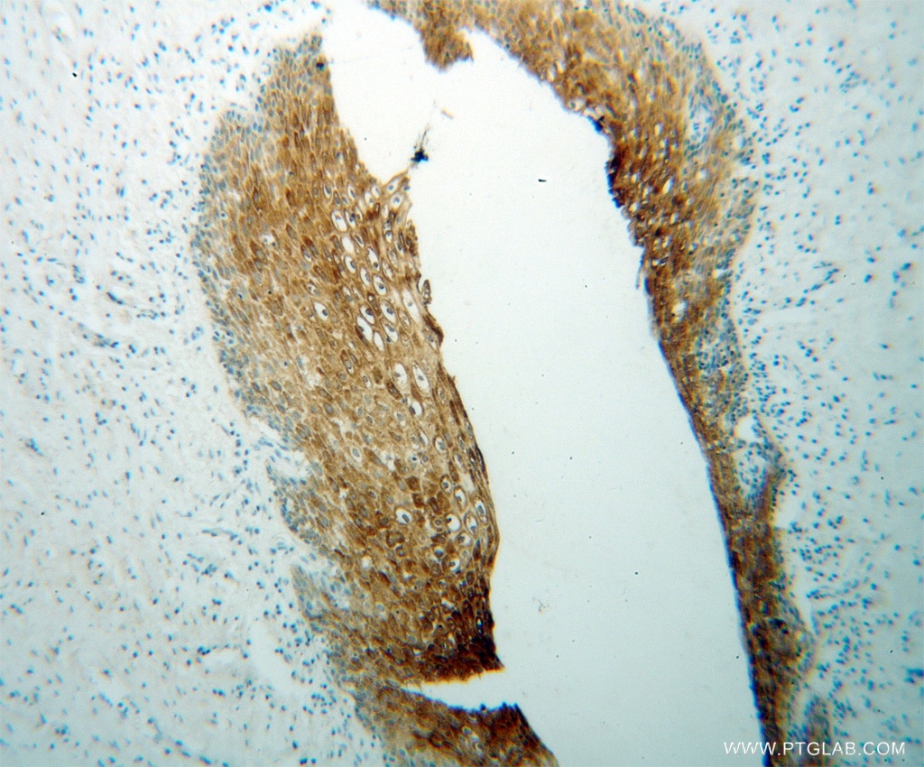 Immunohistochemistry (IHC) staining of human cervical cancer tissue using KIF22 Polyclonal antibody (13403-1-AP)