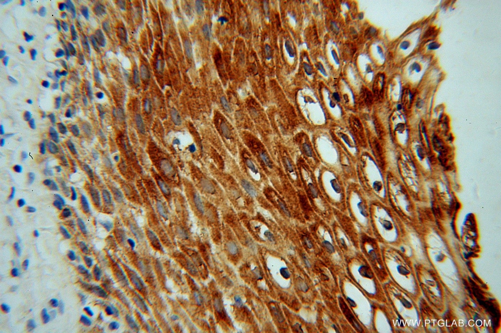 Immunohistochemistry (IHC) staining of human cervical cancer tissue using KIF22 Polyclonal antibody (13403-1-AP)