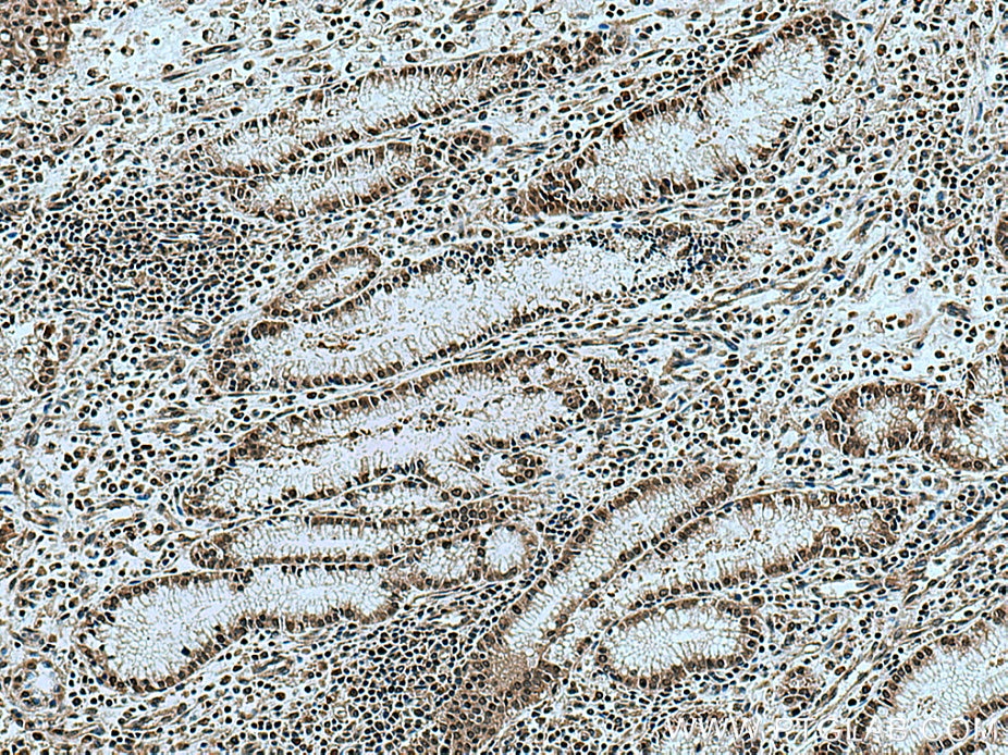 Immunohistochemistry (IHC) staining of human stomach cancer tissue using KIF23 Polyclonal antibody (28587-1-AP)