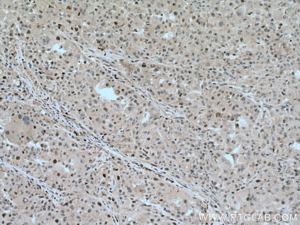 Immunohistochemistry (IHC) staining of human liver cancer tissue using KIF23 Polyclonal antibody (28587-1-AP)