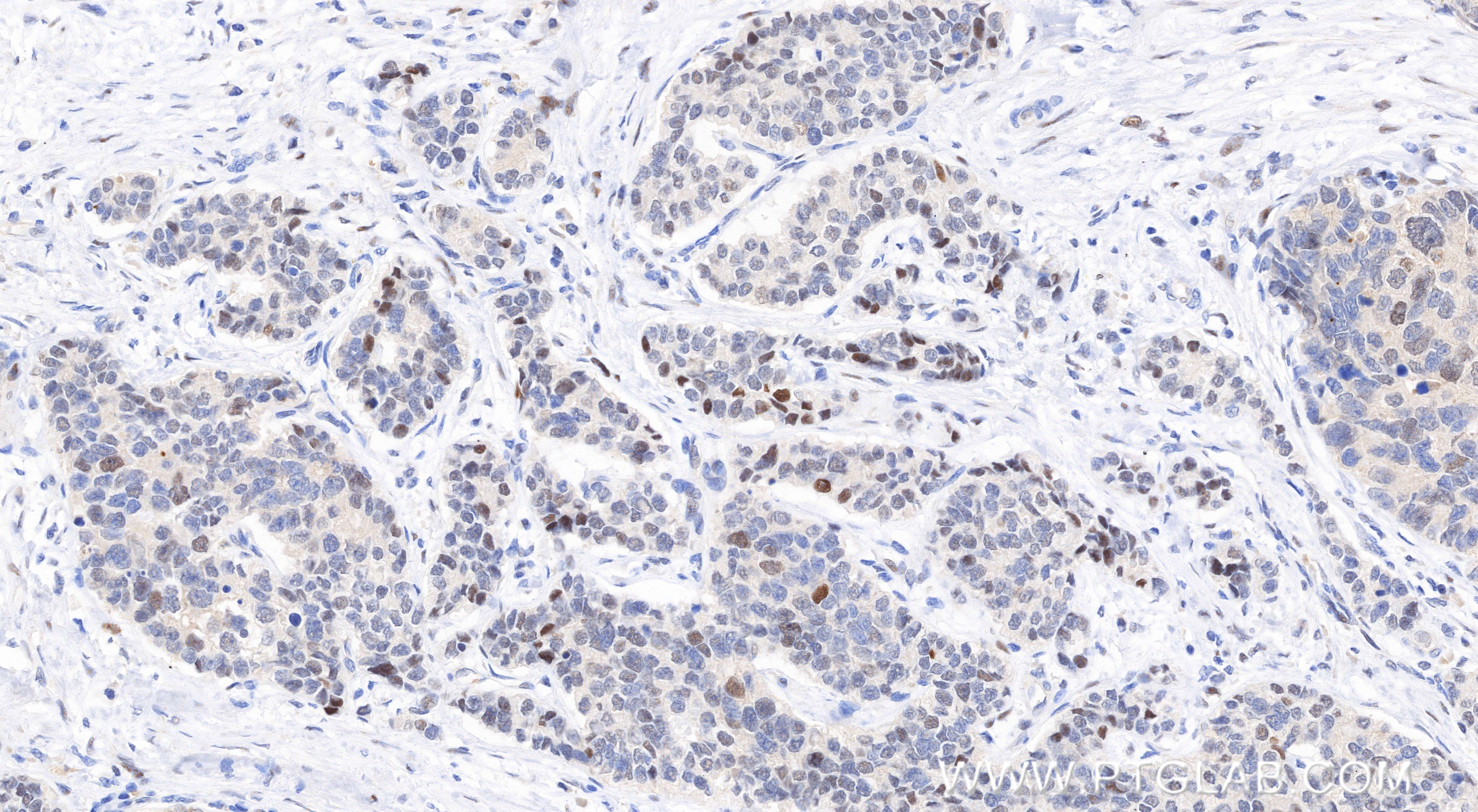 Immunohistochemical analysis of paraffin-embedded human stomach cancer tissue slide using 85675-5-RR (KIF23 antibody) at dilution of 1:1000 (under 20x lens). Heat mediated antigen retrieval with Tris-EDTA buffer (pH 9.0). This data was developed using the same antibody clone with 85675-5-PBS in a different storage buffer formulation. Immunohistochemistry (IHC) staining of human stomach cancer tissue using KIF23 Recombinant monoclonal antibody (85675-5-RR)