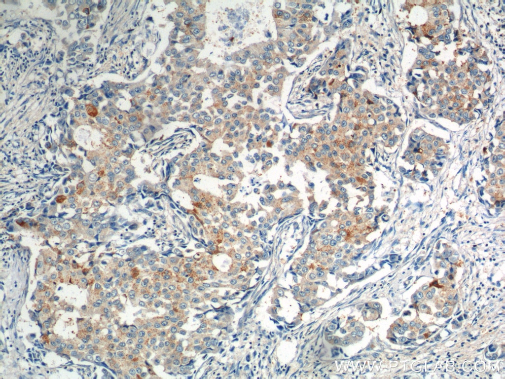 Immunohistochemistry (IHC) staining of human breast cancer tissue using KIF26B Polyclonal antibody (17422-1-AP)