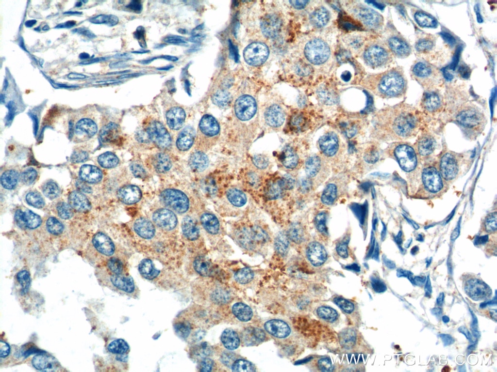 Immunohistochemistry (IHC) staining of human breast cancer tissue using KIF26B Polyclonal antibody (17422-1-AP)