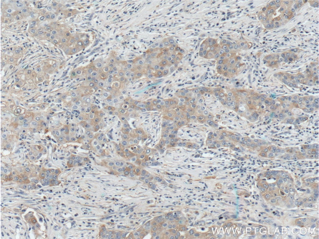 Immunohistochemistry (IHC) staining of human breast cancer tissue using KIF2A Polyclonal antibody (13105-1-AP)