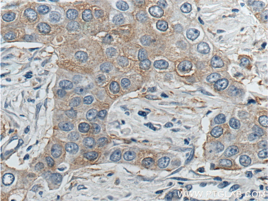 Immunohistochemistry (IHC) staining of human breast cancer tissue using KIF2A Polyclonal antibody (13105-1-AP)