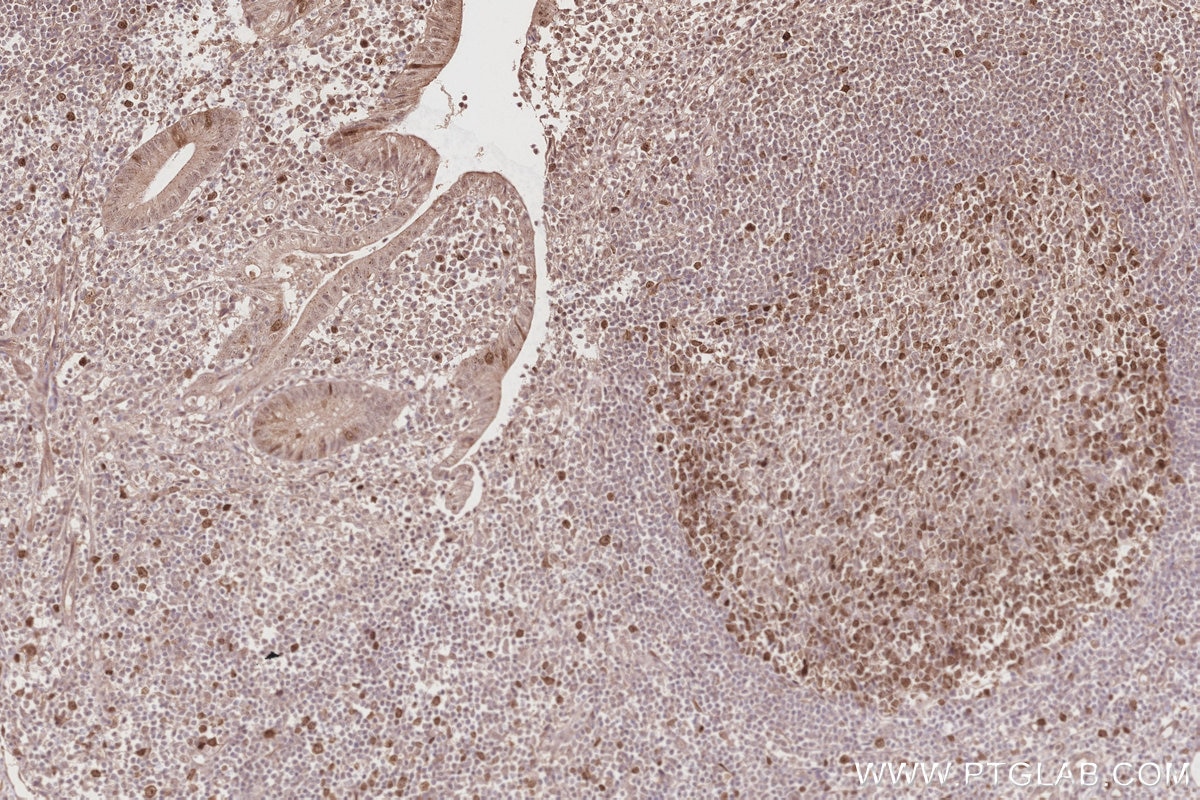Immunohistochemistry (IHC) staining of human appendicitis tissue using KIF2C Polyclonal antibody (28372-1-AP)