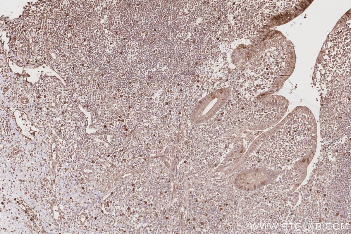 Immunohistochemistry (IHC) staining of human appendicitis tissue using KIF2C Polyclonal antibody (28372-1-AP)