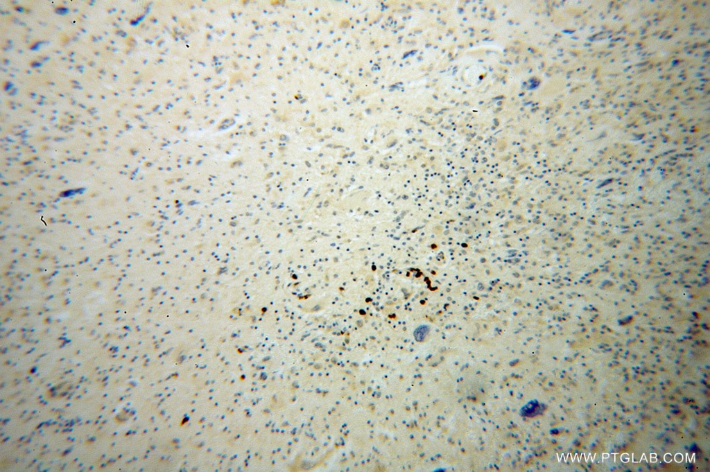 IHC staining of human gliomas using 13930-1-AP