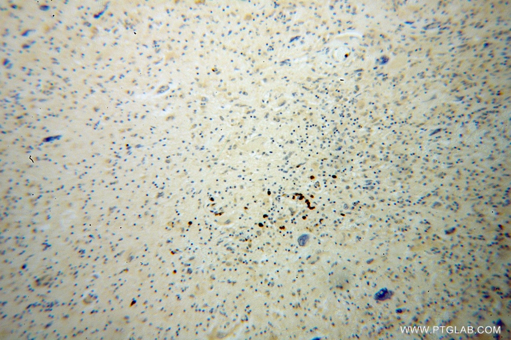 Immunohistochemistry (IHC) staining of human gliomas tissue using KIF3A Polyclonal antibody (13930-1-AP)