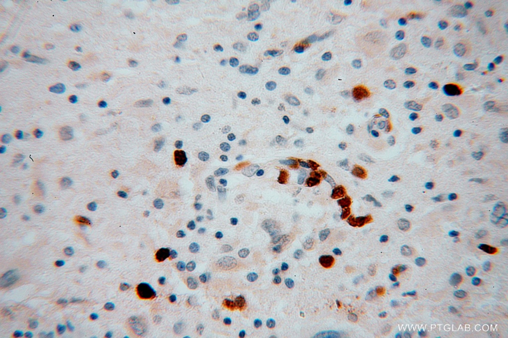 Immunohistochemistry (IHC) staining of human gliomas tissue using KIF3A Polyclonal antibody (13930-1-AP)