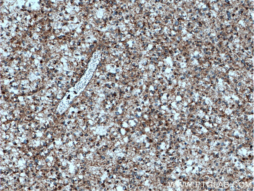 Immunohistochemistry (IHC) staining of human gliomas tissue using KIF3C Polyclonal antibody (14333-1-AP)