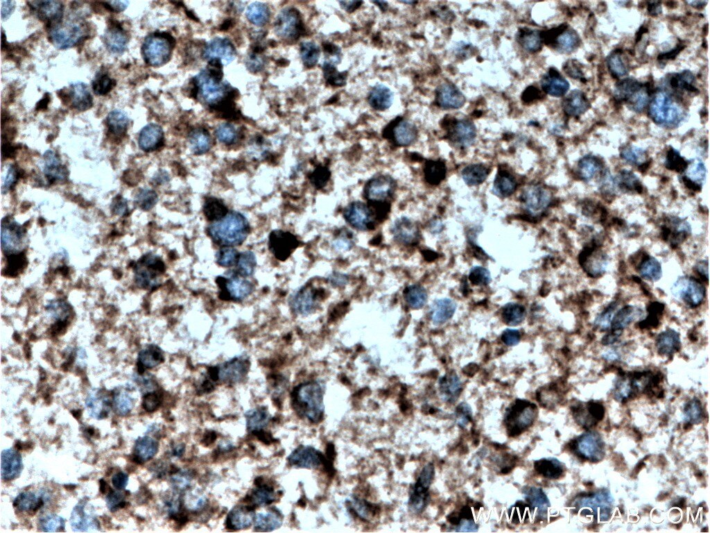 IHC staining of human gliomas using 14333-1-AP